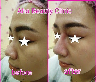 Harga perawatan di AHA beauty clinic