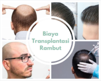 Harga dan Biaya Transplantasi Rambut terbaru